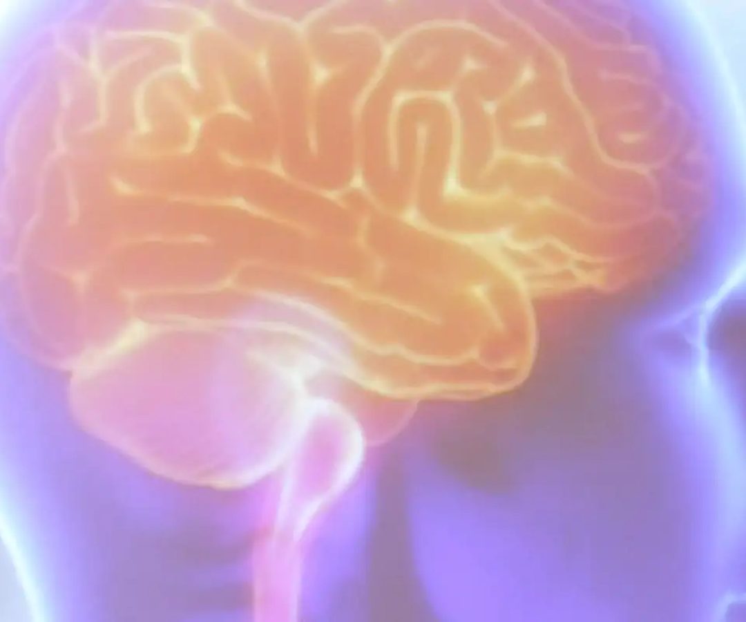 Projeto Ártemis avalia genética de pacientes que sofreram AVC